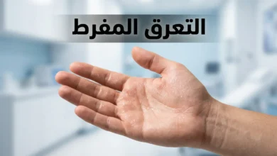 صورة غلاف تُظهر راحة يد بشرية مع قطرات عرق دقيقة على سطح الجلد وعبارة التعرق المفرط بالعربية في أعلى الصورة