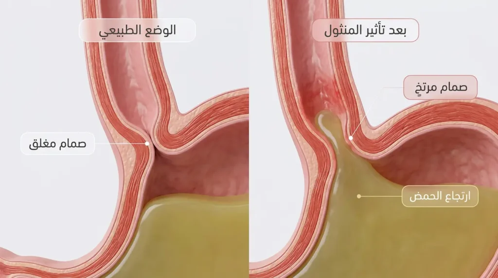 رسم طبي ثلاثي الأبعاد يقارن بين الوضع الطبيعي للعضلة العاصرة السفلى للمريء وحالة ارتخائها بعد تأثير المنثول مسبباً ارتجاع الحمض