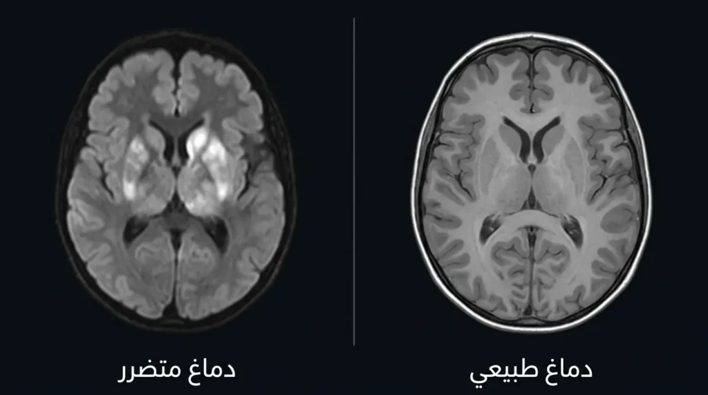 مقارنة بين صورة رنين مغناطيسي لدماغ مولود طبيعي ودماغ مولود متضرر بسبب نقص الأكسجين تُظهر إصابة النوى القاعدية