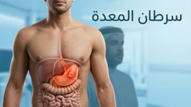 صورة غلاف طبية واقعية تُظهر المعدة داخل الجزء العلوي من الجسم مع عنوان سرطان المعدة