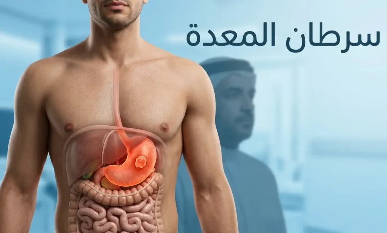صورة غلاف طبية واقعية تُظهر المعدة داخل الجزء العلوي من الجسم مع عنوان سرطان المعدة
