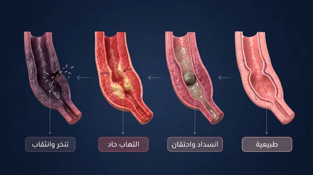 رسم ثلاثي الأبعاد واقعي يوضح مراحل تطور التهاب الزائدة الدودية من الحالة الطبيعية إلى الانسداد ثم الالتهاب الحاد وصولاً إلى التنخر والانثقاب.