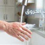 إسعاف الحروق — يد تحت ماء جارٍ بارد من صنبور المطبخ لتبريد حرق سطحي من الدرجة الأولى كإجراء إسعافات أولية صحيح