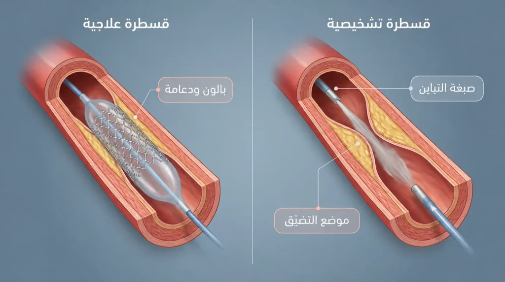 رسم توضيحي طبي واقعي يقارن بين القسطرة التشخيصية التي تحقن صبغة تباين فقط والقسطرة العلاجية التي تستخدم بالوناً ودعامة لتوسيع الشريان التاجي المتضيق