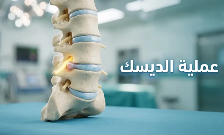 صورة غلاف توضح نموذجاً تشريحياً واقعياً للعمود الفقري القطني مع انزلاق غضروفي في الفقرة L4-L5 وعبارة عملية الديسك