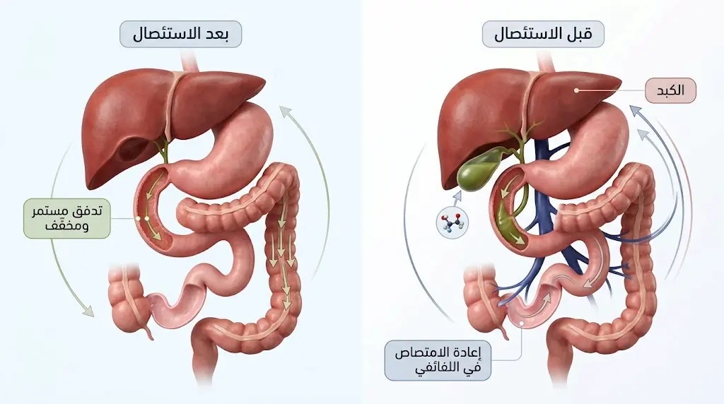 رسم طبي ثلاثي الأبعاد يقارن الدورة المعوية الكبدية للأحماض الصفراوية قبل وبعد استئصال المرارة