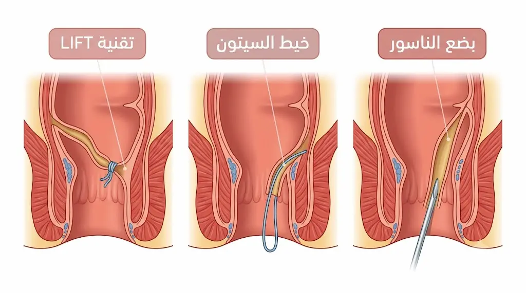 رسم توضيحي طبي يقارن بين ثلاث تقنيات جراحية لعلاج الناسور الشرجي: بضع الناسور وخيط السيتون وتقنية LIFT