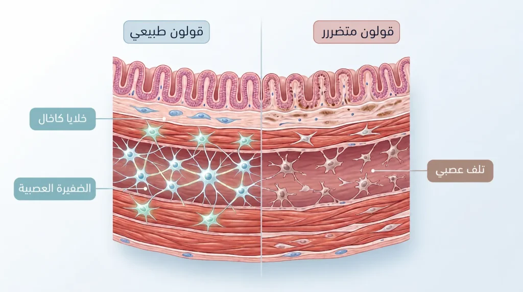 رسم طبي مقارن يوضّح الفرق بين جدار القولون الطبيعي والقولون المتضرر من الإفراط في الملينات المنبّهة على المستوى العصبي