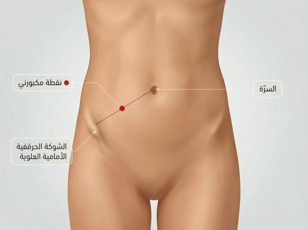 رسم تشريحي واقعي يوضح موقع نقطة مكبورني على جدار البطن الأمامي بين السرّة والشوكة الحرقفية الأمامية العلوية اليمنى.