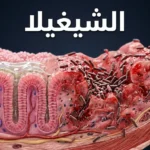 صورة غلاف توضيحية ثلاثية الأبعاد تُظهر بكتيريا الشيغيلا وهي تغزو جدار القولون مع مقارنة بين النسيج السليم والملتهب