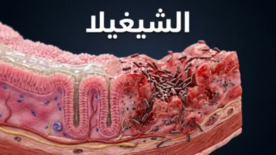 صورة غلاف توضيحية ثلاثية الأبعاد تُظهر بكتيريا الشيغيلا وهي تغزو جدار القولون مع مقارنة بين النسيج السليم والملتهب
