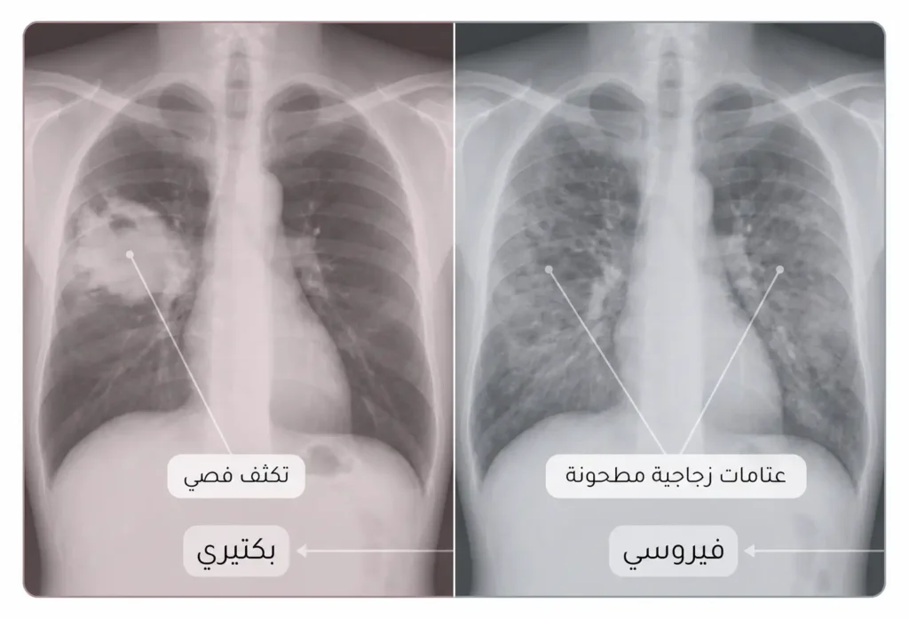 صورة مقارنة شعاعية تشرح الفرق بين مظهر التهاب الرئة البكتيري والفيروسي.