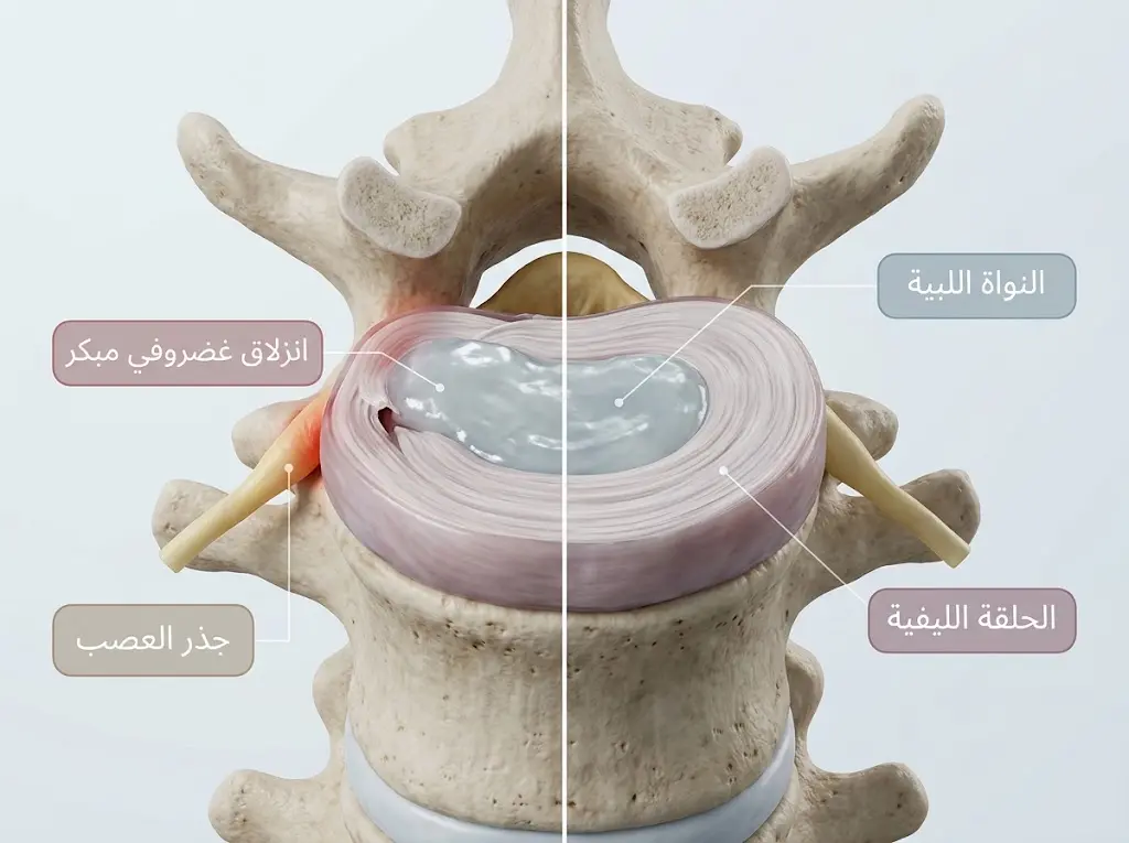 مقطع تشريحي ثلاثي الأبعاد يُقارن بين قرص غضروفي عنقي سليم وآخر في مرحلة انزلاق مبكر مع انضغاط جذر العصب