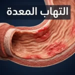 صورة غلاف توضيحية ثلاثية الأبعاد تُظهر مقطعاً عرضياً لجدار المعدة مع غشاء مخاطي ملتهب ومتهيّج، مع عنوان "التهاب المعدة" بالعربية.