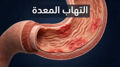 صورة غلاف توضيحية ثلاثية الأبعاد تُظهر مقطعاً عرضياً لجدار المعدة مع غشاء مخاطي ملتهب ومتهيّج، مع عنوان "التهاب المعدة" بالعربية.