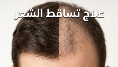 مقارنة بصرية بين فروة رأس بشعر كثيف وفروة أخرى تعاني من التساقط، مع عنوان "علاج تساقط الشعر"