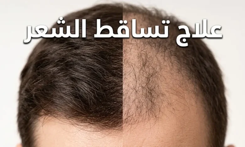 مقارنة بصرية بين فروة رأس بشعر كثيف وفروة أخرى تعاني من التساقط، مع عنوان "علاج تساقط الشعر"