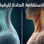 رسم طبي ثلاثي الأبعاد يُظهر الفرق بين العمود الفقري العنقي الطبيعي ذي الانحناء القوسي والعمود الفقري العنقي المستقيم (الاستقامة الحادة للرقبة)