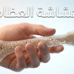 صورة غلاف مقال هشاشة العظام تظهر يدًا تحمل نموذجًا ثلاثي الأبعاد لعظم فخذ يكشف عن بنية داخلية مسامية وهشة