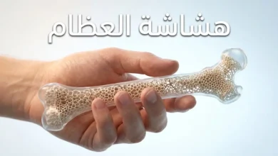صورة غلاف مقال هشاشة العظام تظهر يدًا تحمل نموذجًا ثلاثي الأبعاد لعظم فخذ يكشف عن بنية داخلية مسامية وهشة