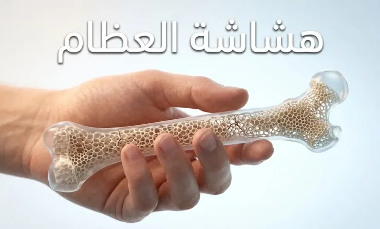 صورة غلاف مقال هشاشة العظام تظهر يدًا تحمل نموذجًا ثلاثي الأبعاد لعظم فخذ يكشف عن بنية داخلية مسامية وهشة