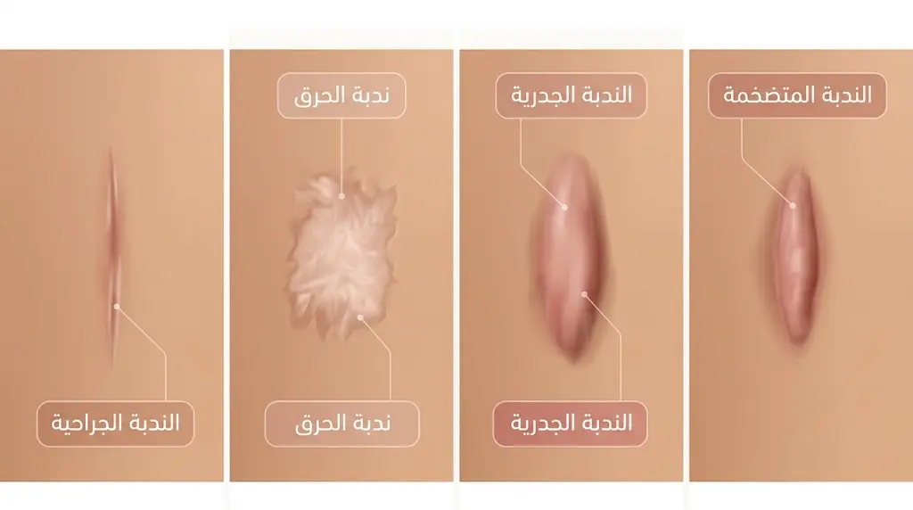 مقارنة بصرية بين أنواع الندبات المستجيبة للعلاج بلصقات السيليكون