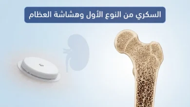 صورة طبية توضيحية تُظهر مقطعًا عرضيًّا لعظم الفخذ مع تدرج من العظم الكثيف السليم إلى العظم الهش المسامي، بجانب رمز لجهاز مراقبة الغلوكوز وظل كلية، مع عنوان السكري من النوع الأول وهشاشة العظام