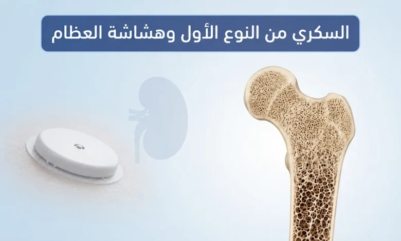 صورة طبية توضيحية تُظهر مقطعًا عرضيًّا لعظم الفخذ مع تدرج من العظم الكثيف السليم إلى العظم الهش المسامي، بجانب رمز لجهاز مراقبة الغلوكوز وظل كلية، مع عنوان السكري من النوع الأول وهشاشة العظام