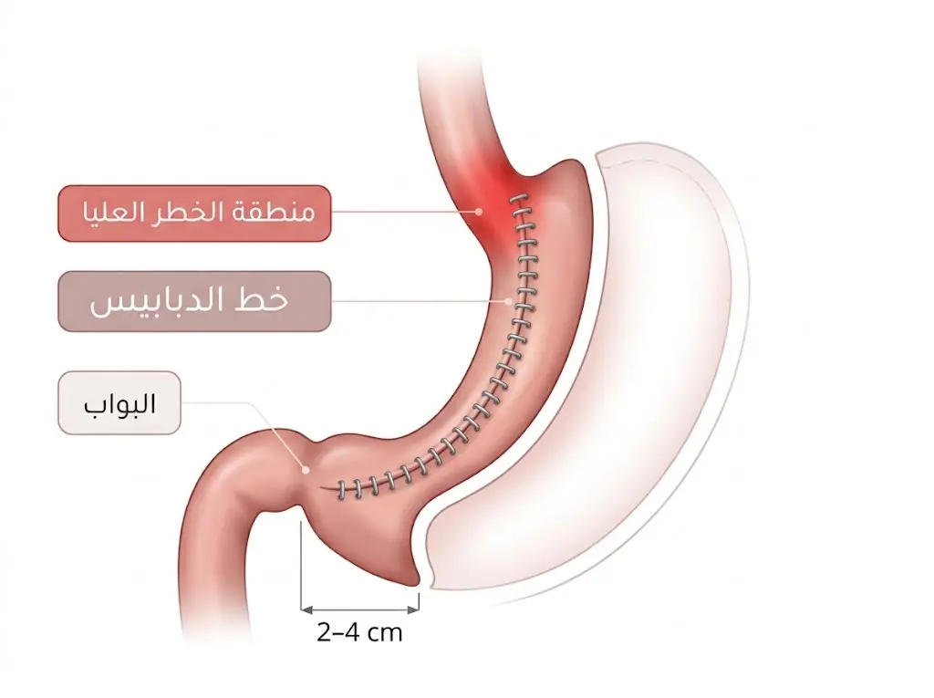 رسم طبي يوضح موضع خط الدبابيس في عملية تكميم المعدة ومنطقة الخطر العليا قرب الموصل المعدي المريئي