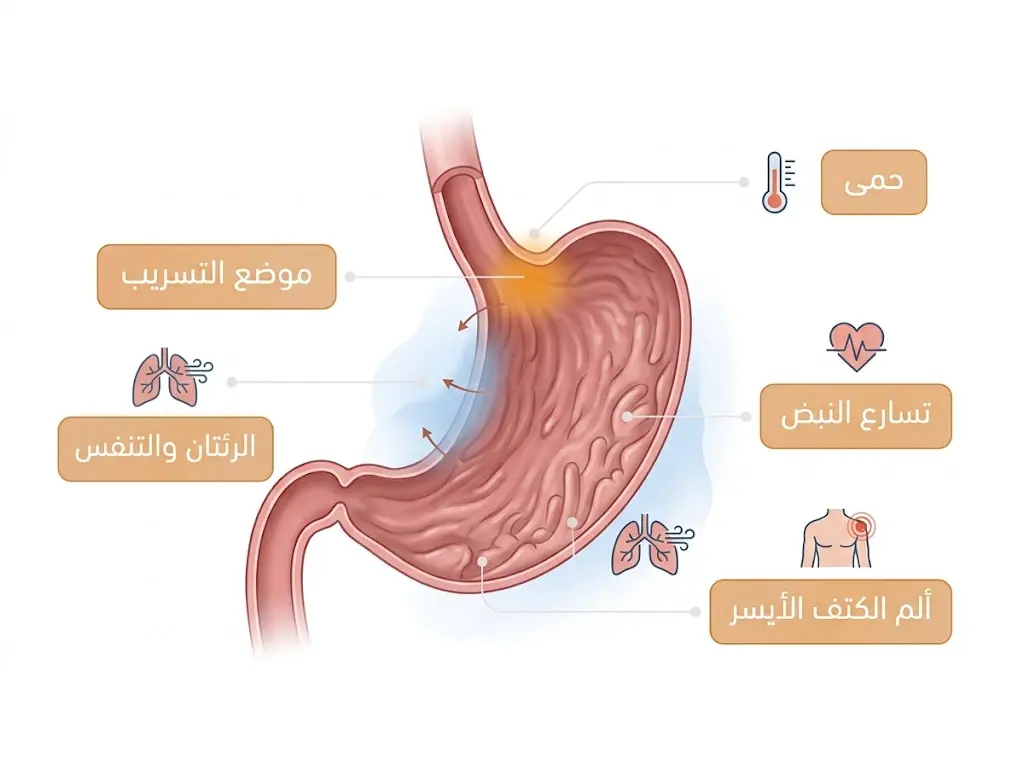 رسم طبي يوضح موضع تسريب خط الدبابيس وأبرز الأعراض التحذيرية المبكرة بعد تكميم المعدة