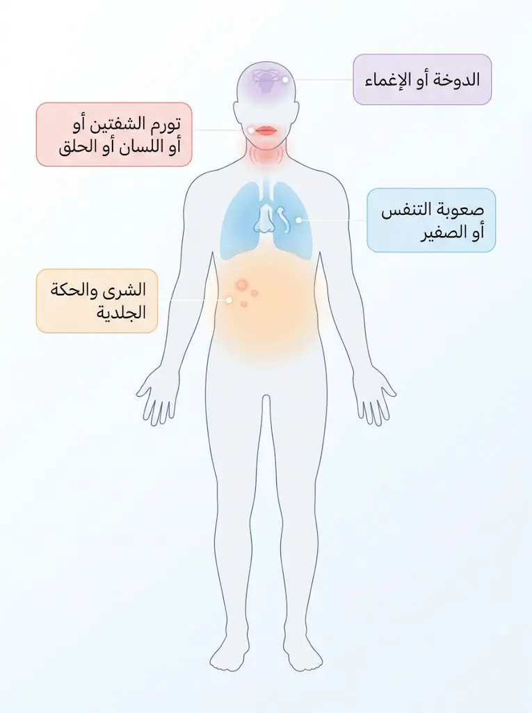 خريطة توضيحية لأعراض التأق على الجسم تشمل تورم الوجه والحلق والشرى الجلدي وصعوبة التنفس والدوخة