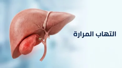 رسم ثلاثي الأبعاد يوضح الكبد والمرارة الملتهبة مع حصاة سادة للقناة المرارية