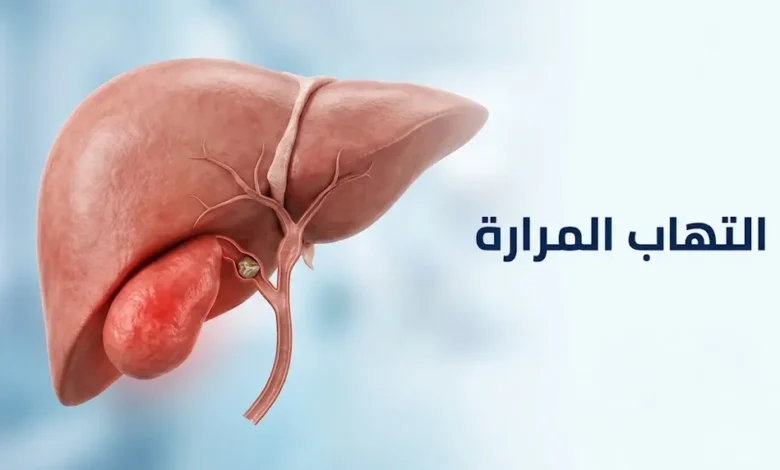 رسم ثلاثي الأبعاد يوضح الكبد والمرارة الملتهبة مع حصاة سادة للقناة المرارية
