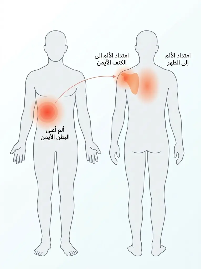 خريطة توضح موضع ألم التهاب المرارة في أعلى البطن الأيمن وامتداده إلى الكتف والظهر