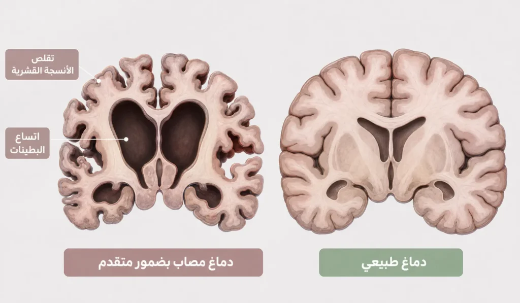 مقارنة تشريحية بين دماغ طبيعي ودماغ مصاب بضمور مرتبط بمرض الزهايمر