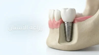 زراعة الأسنان: نموذج ثلاثي الأبعاد لزرعة سن مثبتة داخل عظم الفك مع التاج الظاهر فوق اللثة