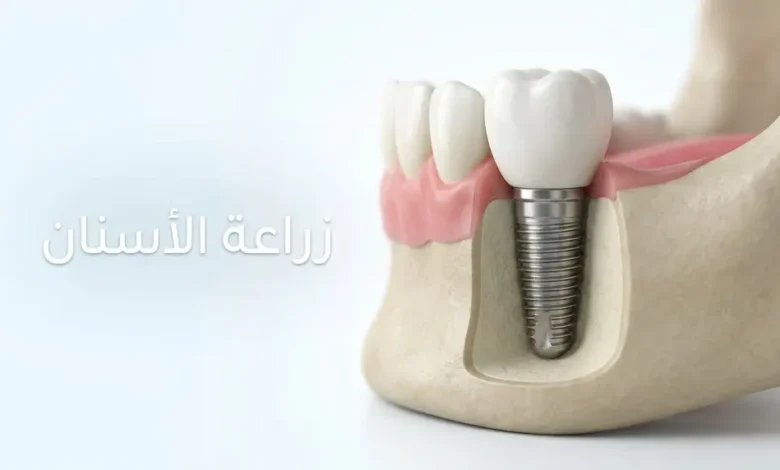 زراعة الأسنان: نموذج ثلاثي الأبعاد لزرعة سن مثبتة داخل عظم الفك مع التاج الظاهر فوق اللثة