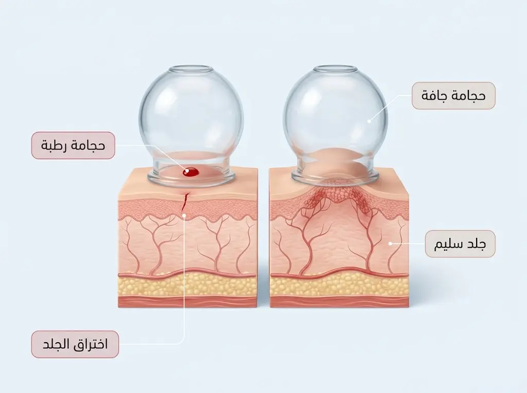 الفرق بين الحجامة الجافة والحجامة الرطبة من حيث اختراق الجلد