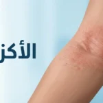 صورة غلاف توضيحية لمرض الأكزيما وأعراضها الجلدية