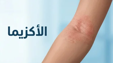 صورة غلاف توضيحية لمرض الأكزيما وأعراضها الجلدية