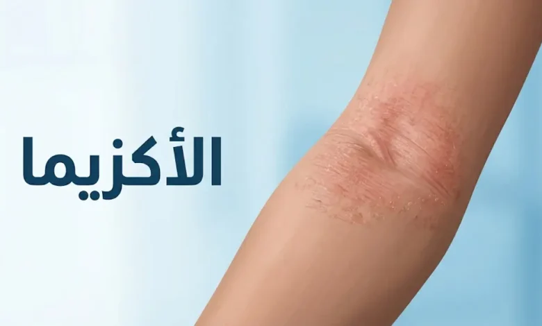 صورة غلاف توضيحية لمرض الأكزيما وأعراضها الجلدية