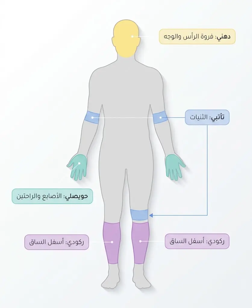 إنفوغرافيك يوضح أماكن ظهور أنواع الأكزيما المختلفة على جسم الإنسان