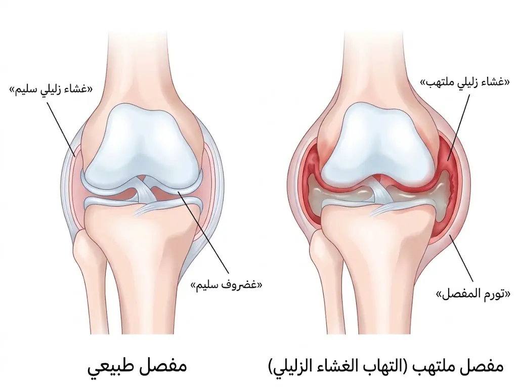 مقارنة تشريحية بين مفصل سليم ومفصل مصاب بالتهاب الغشاء الزليلي (Synovitis).
