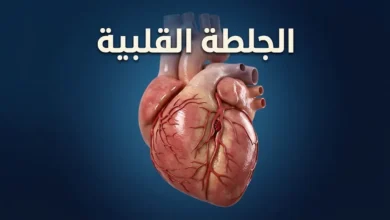 قلب بشري ثلاثي الأبعاد يوضح انسداد شريان تاجي بخثرة دموية، تمثيلاً للجلطة القلبية