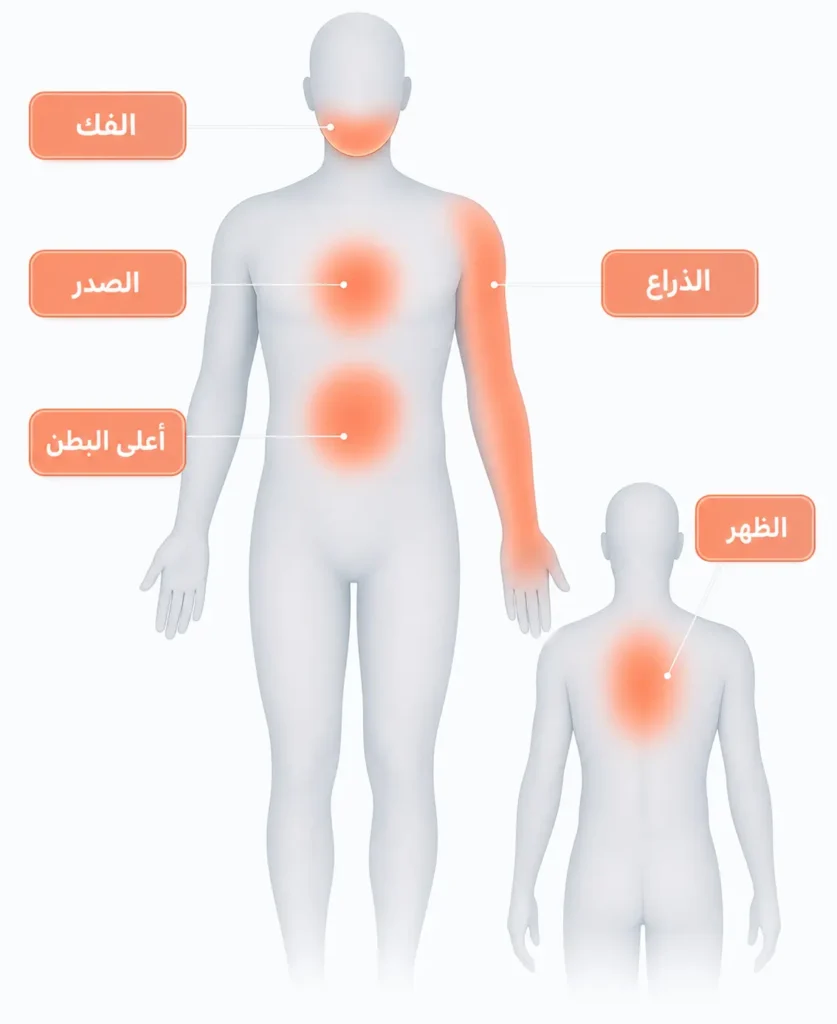 مخطط جسدي يوضح مناطق انتشار ألم الجلطة القلبية في الصدر والذراع والفك والظهر وأعلى البطن