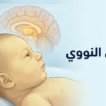 رسم طبي توضيحي لمولود حديث الولادة مع إشارة إلى تأثر الدماغ بسمية البيليروبين في اليرقان النووي