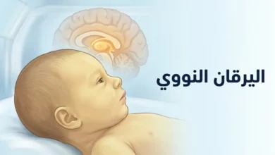 رسم طبي توضيحي لمولود حديث الولادة مع إشارة إلى تأثر الدماغ بسمية البيليروبين في اليرقان النووي