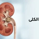 رسم توضيحي طبي لكلية بشرية يظهر حصاة كلوية داخل حوض الكلية