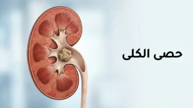 رسم توضيحي طبي لكلية بشرية يظهر حصاة كلوية داخل حوض الكلية