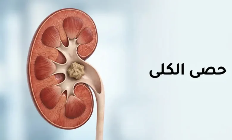 رسم توضيحي طبي لكلية بشرية يظهر حصاة كلوية داخل حوض الكلية